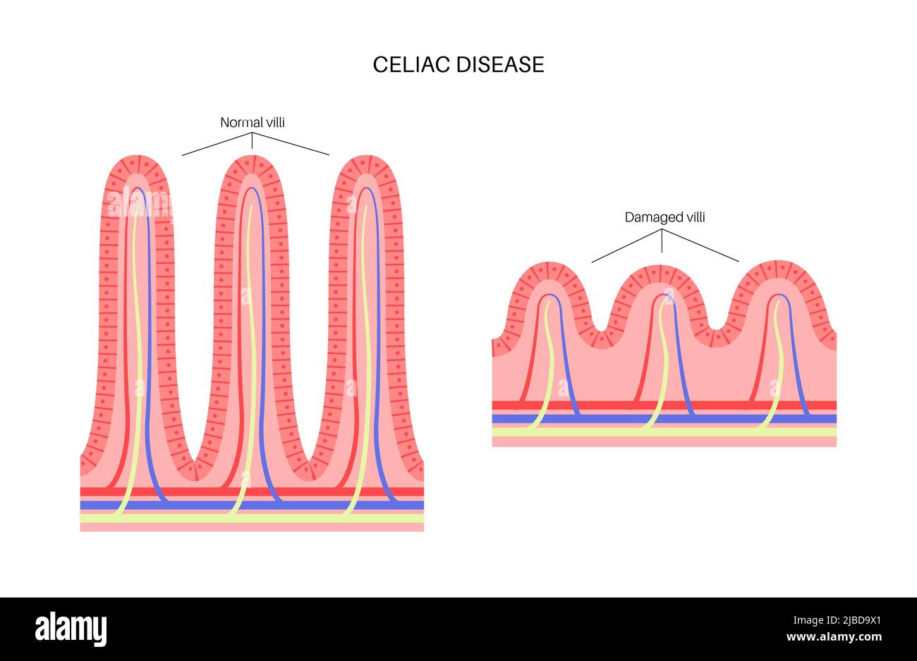 Celiac disease inflammation, illustration Stock Photo - Alamy