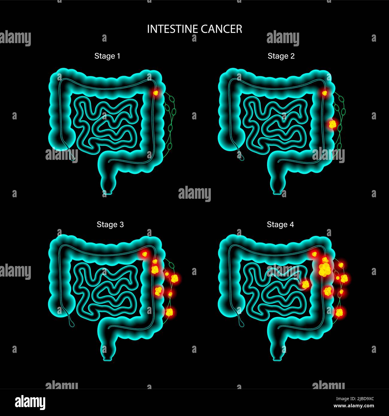 Intestinal cancer, illustration Stock Photo