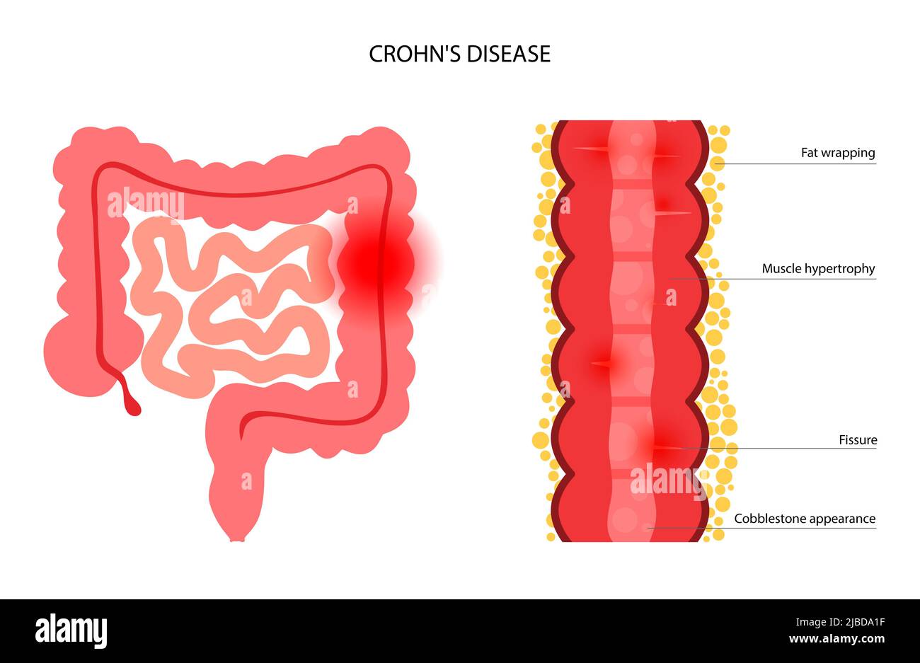 Chron's disease, conceptual illustration Stock Photo - Alamy