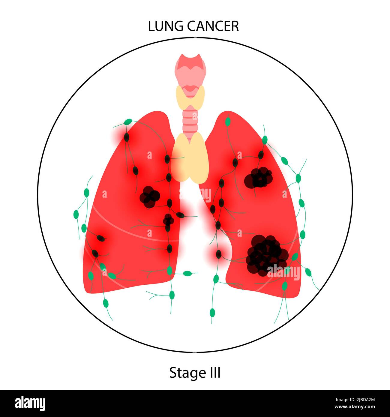 Lungs Cancer Illustration Stock Photo Alamy