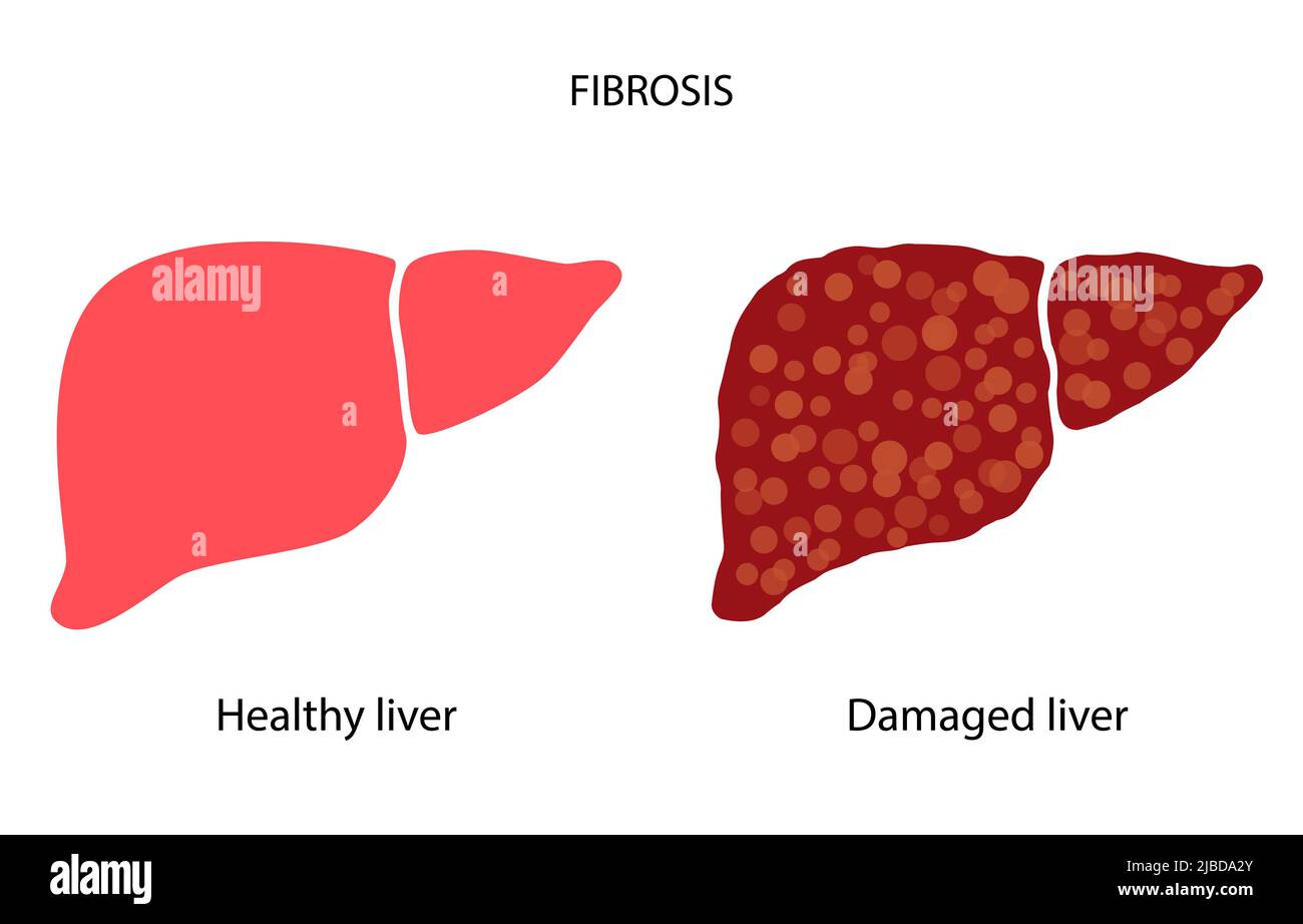 Liver disease, illustration Stock Photo Alamy