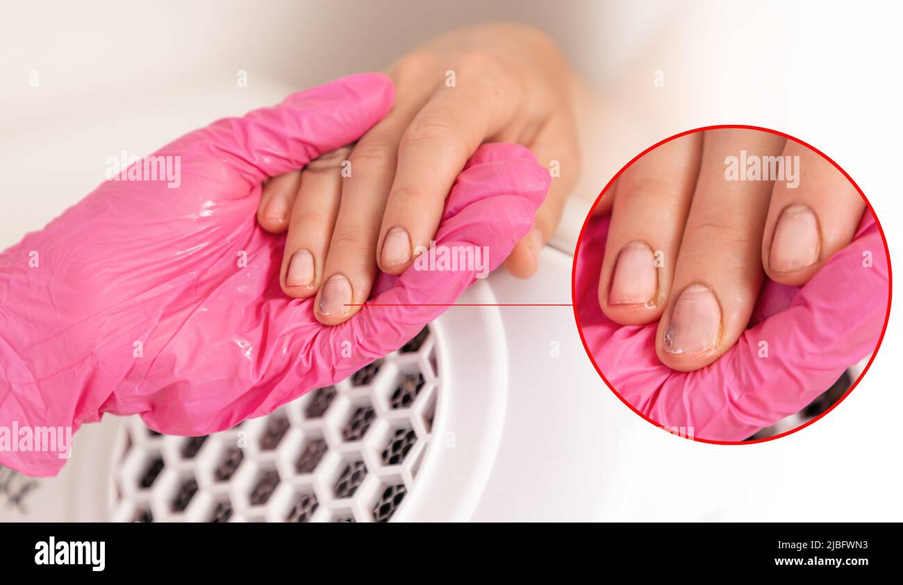 Manicurist in pink medical gloves holds a client's hand with dirty, sore nails. Close-up. The concept of problems and fungal nail damage. Stock Photo