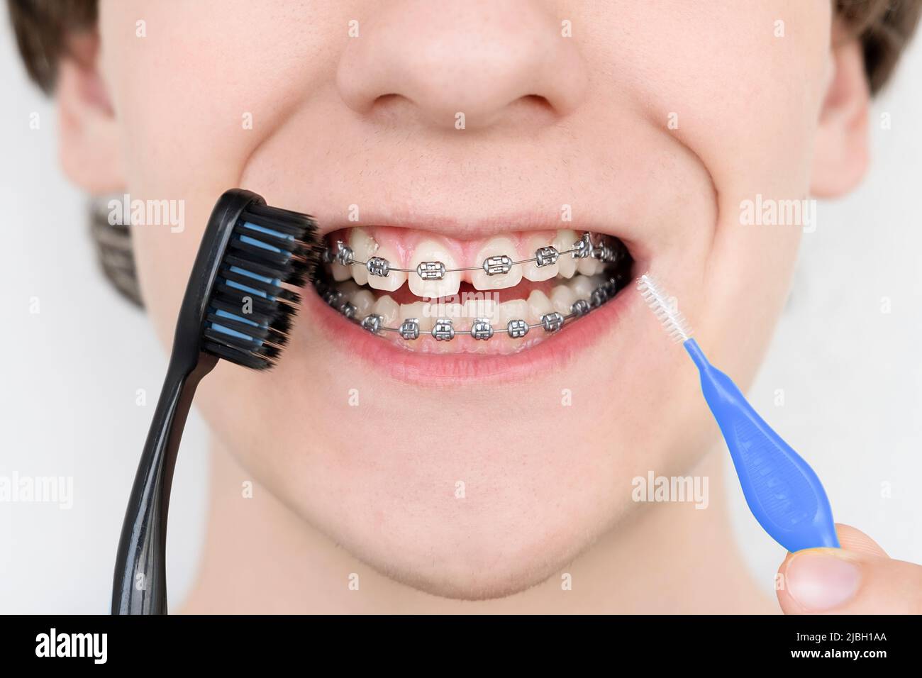 Young man with dental braces holding brushes for cleaning his teeth. Stock Photo