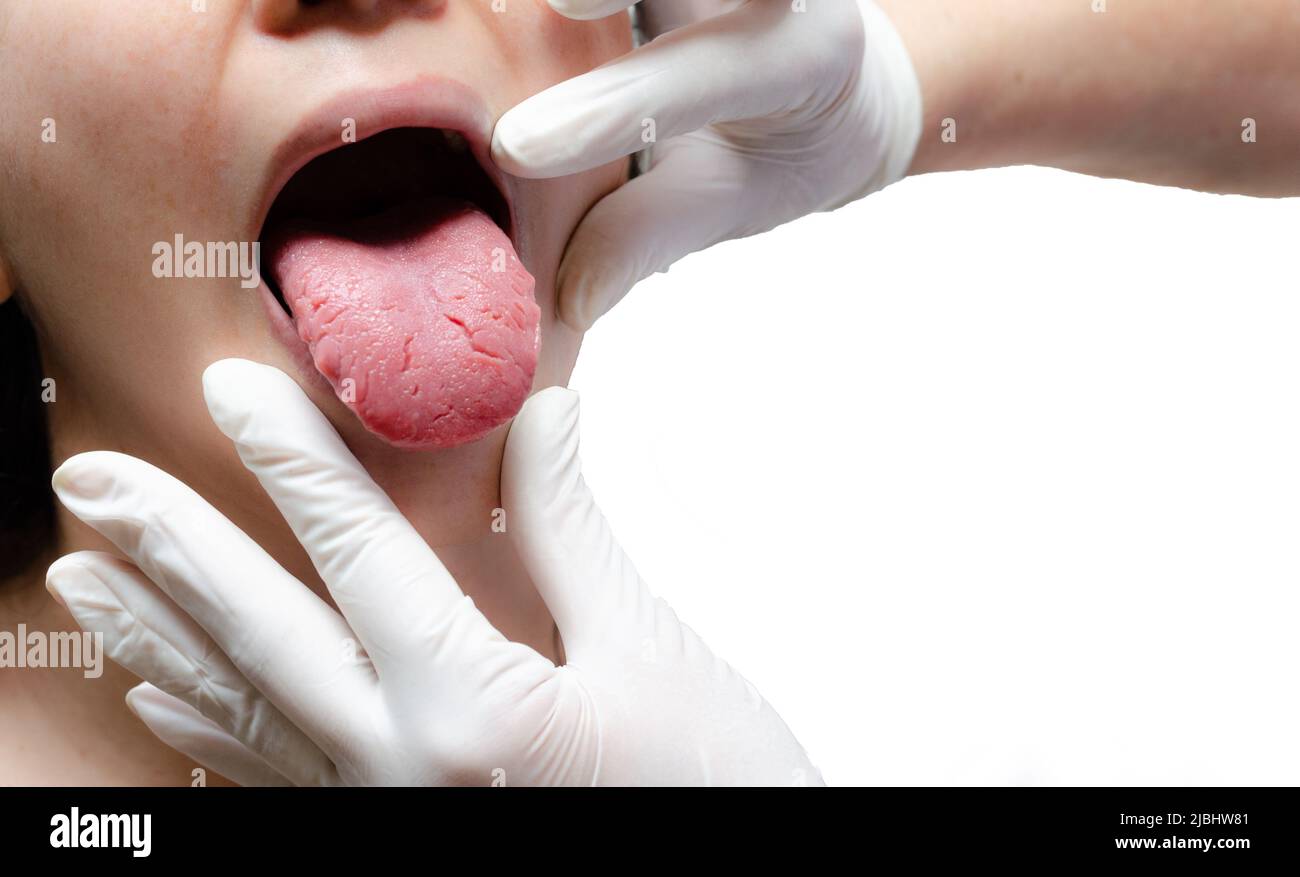 Tongue of a young Caucasian woman with benign migratory glossitis, held by a doctor wearing white gloves. Tongue with candidiasis. Cracks in the tongu Stock Photo