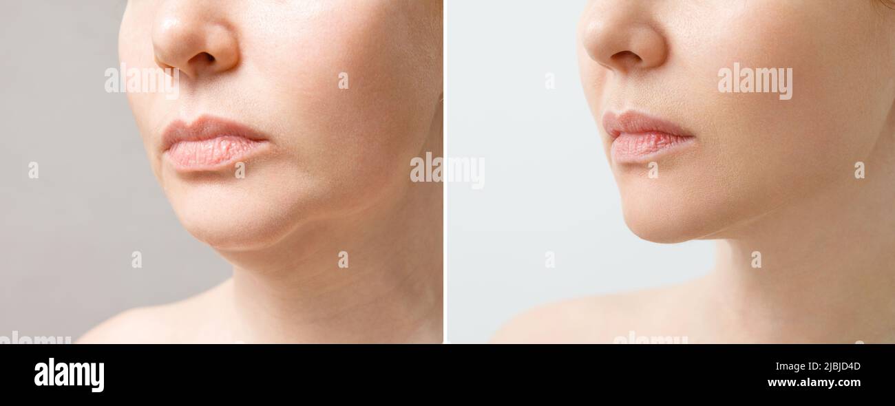 Female double chin before and after correction. Correction of the chin shape liposuction of the neck. The result of the procedure in the clinic of Stock Photo