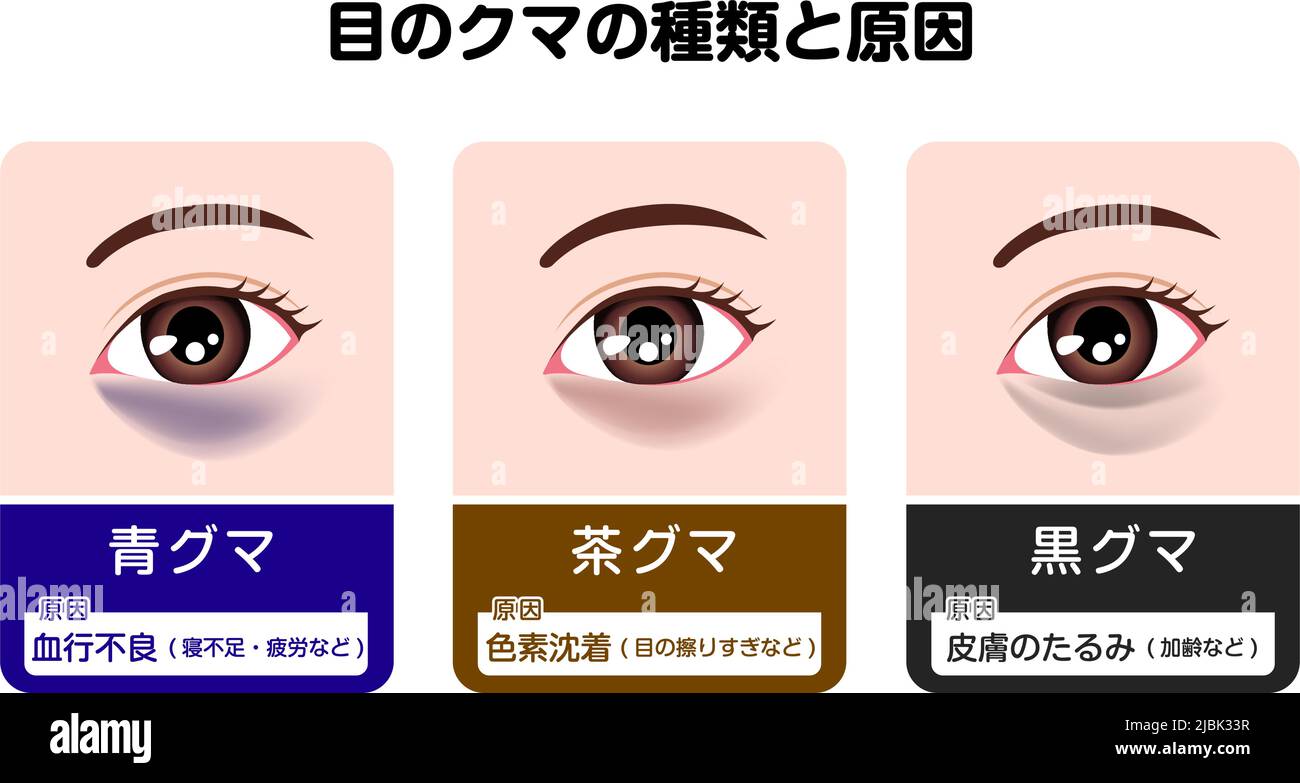 Types and causes of dark circles under eyes. Vector illustration