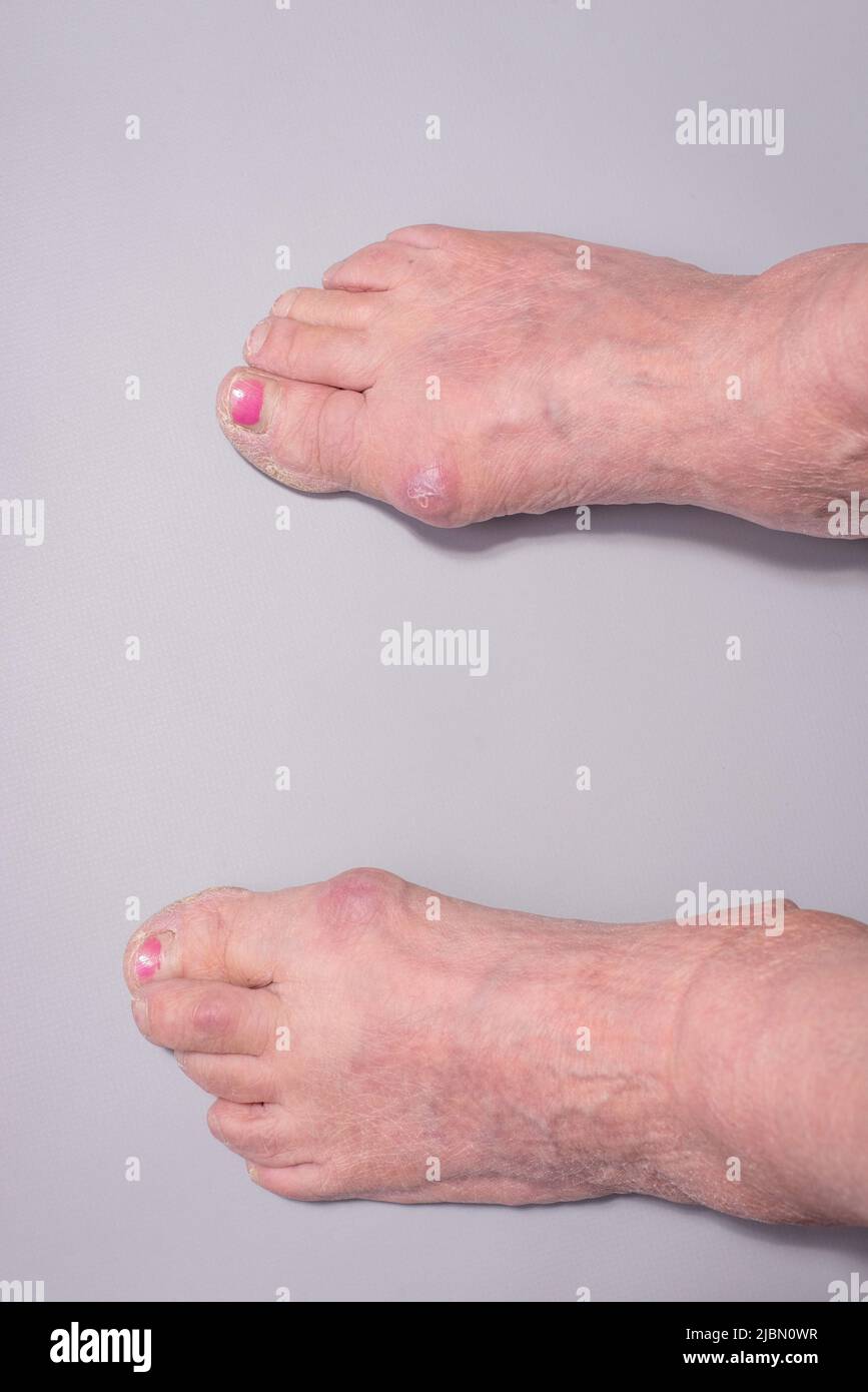 close-up of big toe disease curvature in elderly woman on gray background Stock Photo