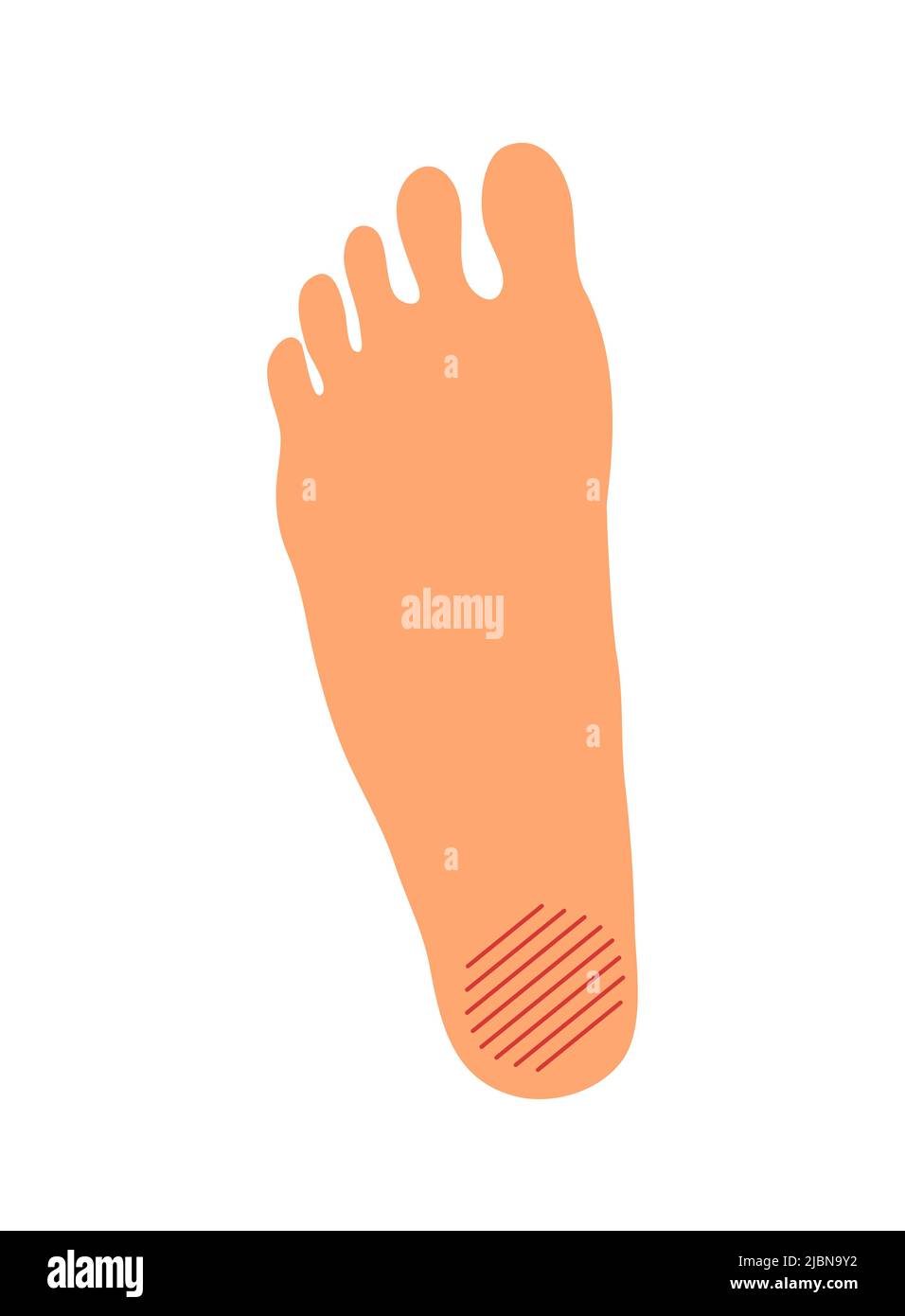Plantar fasciitis problem on the female foot. Orthopedic deformity of the joint and bone. Women leg. Disease, pain and healing. Health care. Vector il Stock Vector