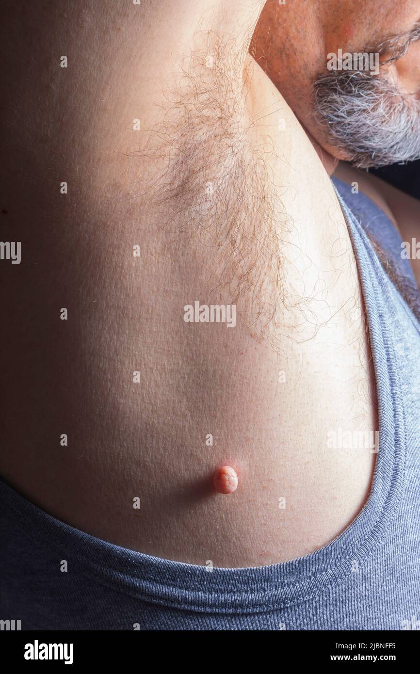 Close Up photo of skin tag or skin mole on a human body before medical  dermatologist treatment with liquid nitrogen. Skin mole tag removal.  Dermatolog Stock Photo - Alamy