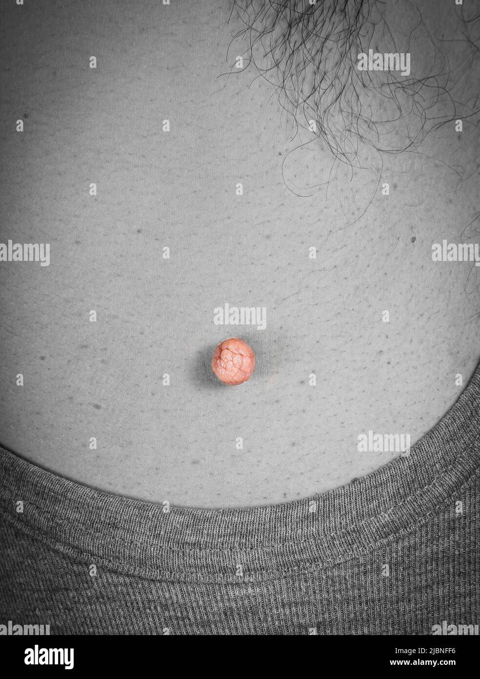 Close Up photo of skin tag or skin mole on a human body before medical