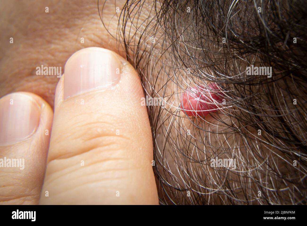 Closeup photo of Cherry Angioma skin tag or skin mole on human head in the  hair Stock Photo - Alamy