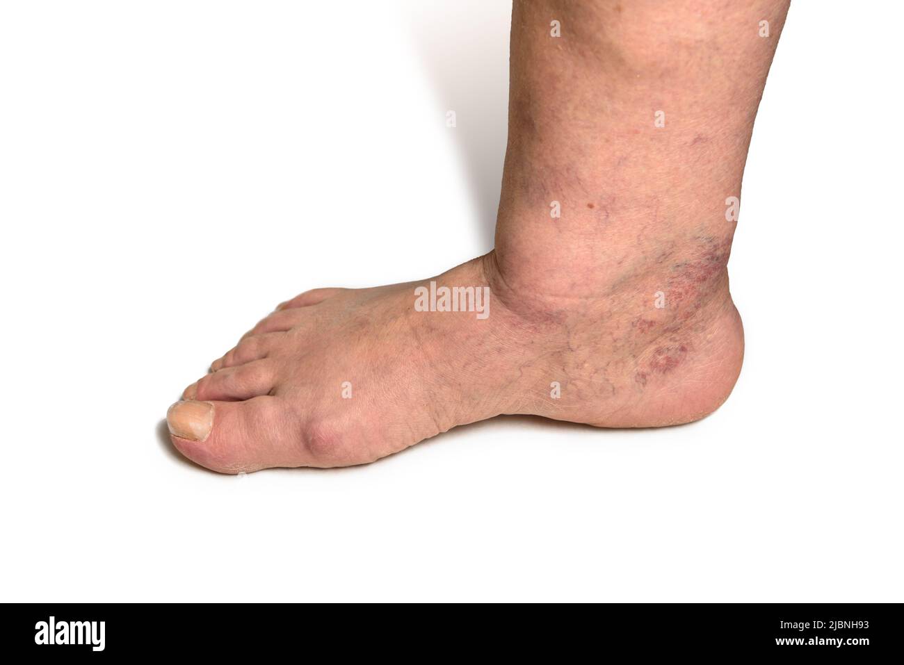 Swelling female leg with inflammation in diabetic nephropathy and varicose veins. Elderly woman