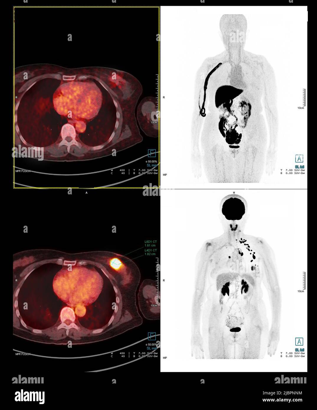 Normal Pet Scan Images normal-pet-scan-images