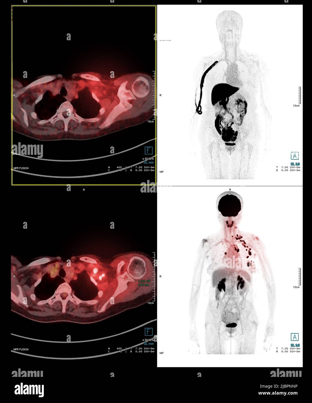 PET Scan image of whole human body for detect cancer recurrence after