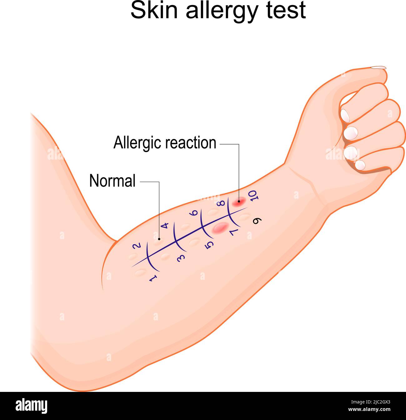 Skin allergy test. Human arm with small amount of the allergen. normal reaction and immune response in the form of a rash. Vector illustration Stock Vector