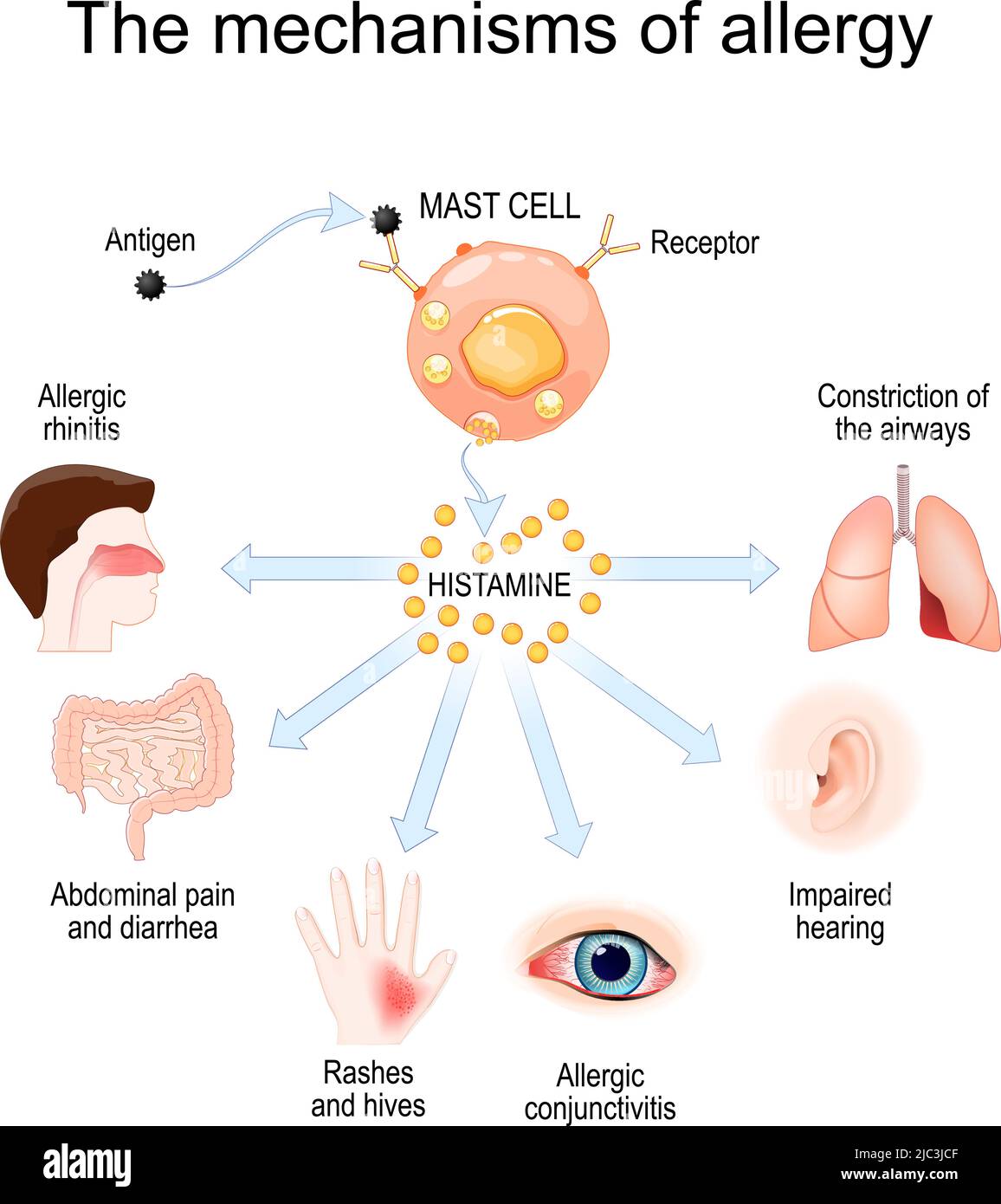 Mechanism of allergy. Mast cells and allergic reaction. Histamine. local immune responses. vector illustration Stock Vector