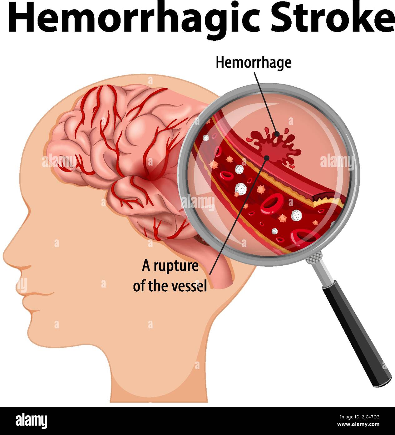 Human With Hemorrhagic Stroke Illustration Stock Vector Image And Art Alamy