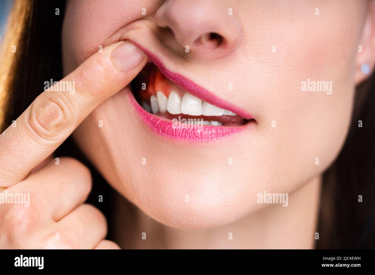 Close-up Of A Woman's Finger Showing Swelling Of Her Gum Stock Photo