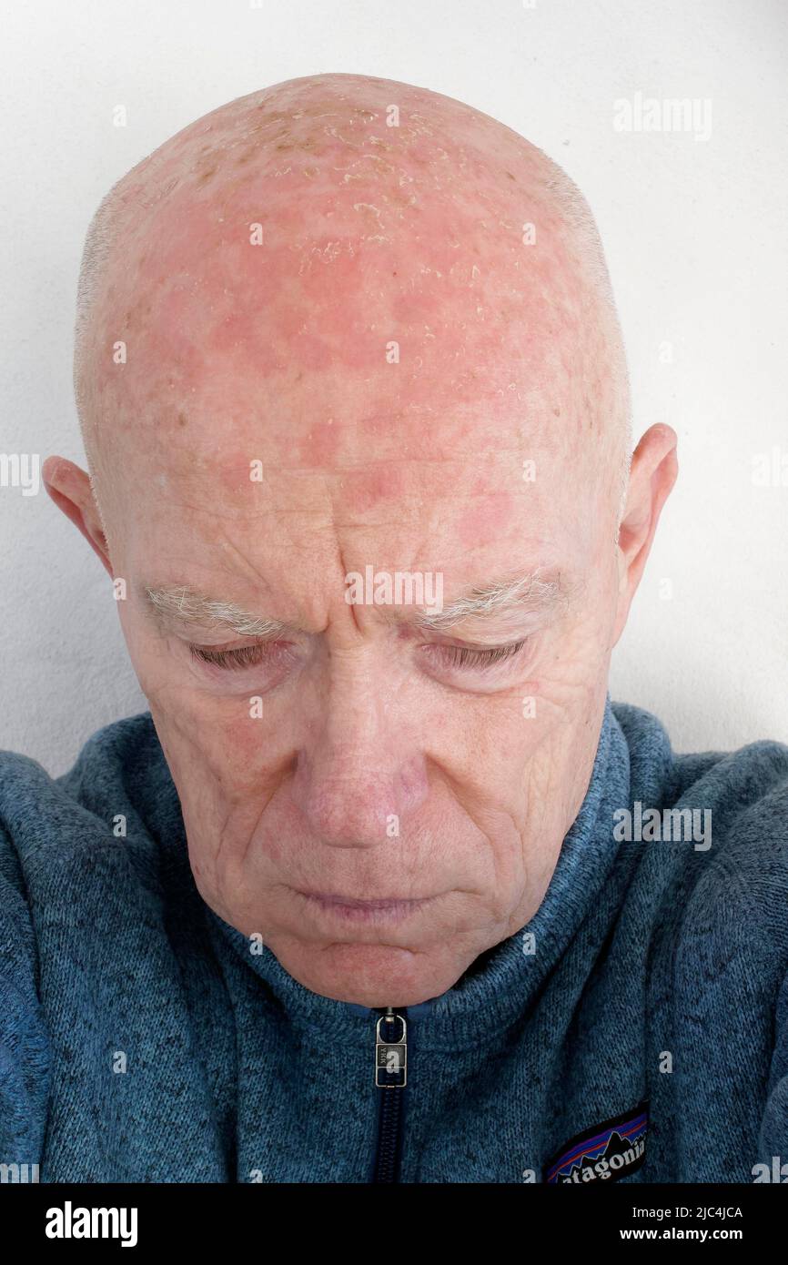 Man, 71, patient, head, bald head, face, with light shadows, actinic keratosis, nine days after photodynamic therapy (PDT), laser treatment, lasered Stock Photo