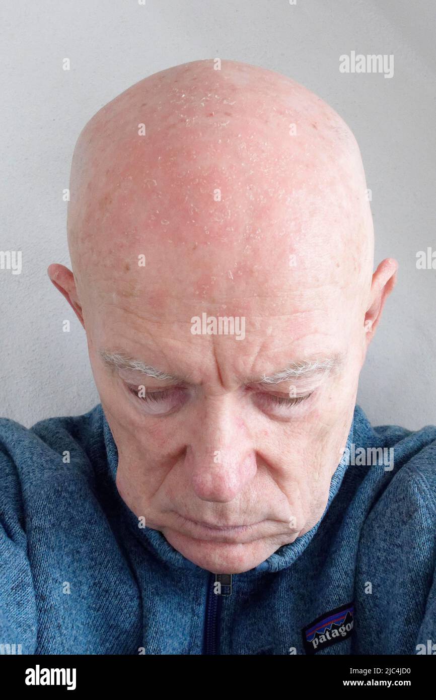 Man, 71, patient, head, bald head, face, with light shadows, actinic keratosis, twelve days after photodynamic therapy (PDT), laser treatment Stock Photo