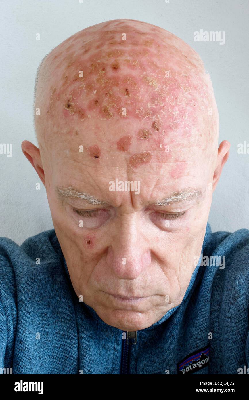 Man, 71, patient, head, bald, face, with light damage, actinic keratosis,  six days after photodynamic therapy (PDT), laser treatment, lasered, Ameluz  Stock Photo - Alamy