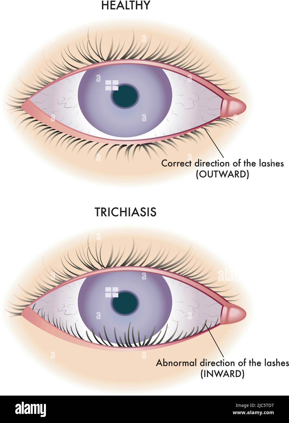 Medical illustration shows the comparison between a normal eye and one affected by trichiasis. Stock Vector
