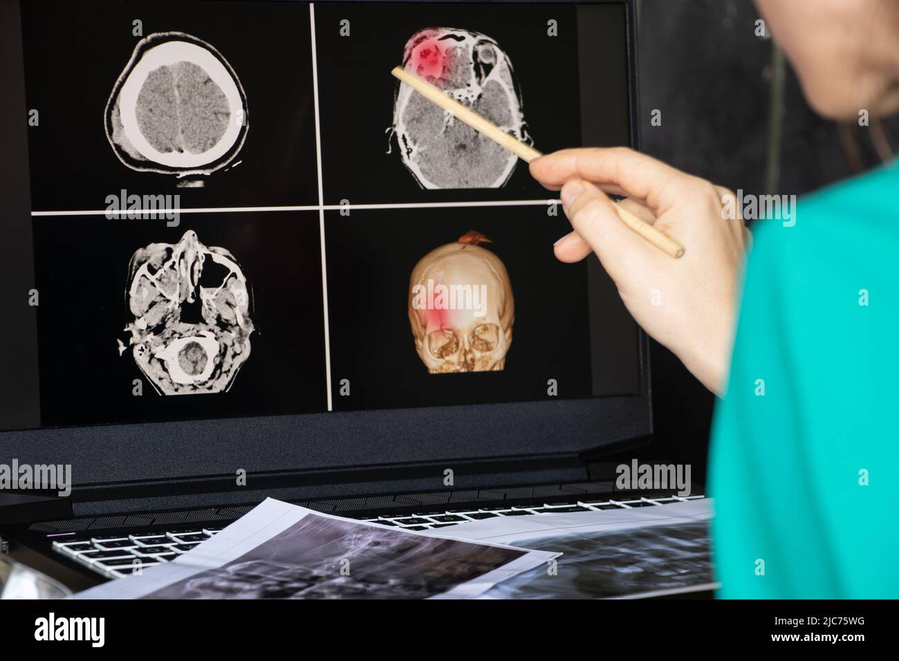 3D computed tomography of the brain with a fracture of the frontal part of the skull after injury on laptop screens on the table on laptop screens at Stock Photo