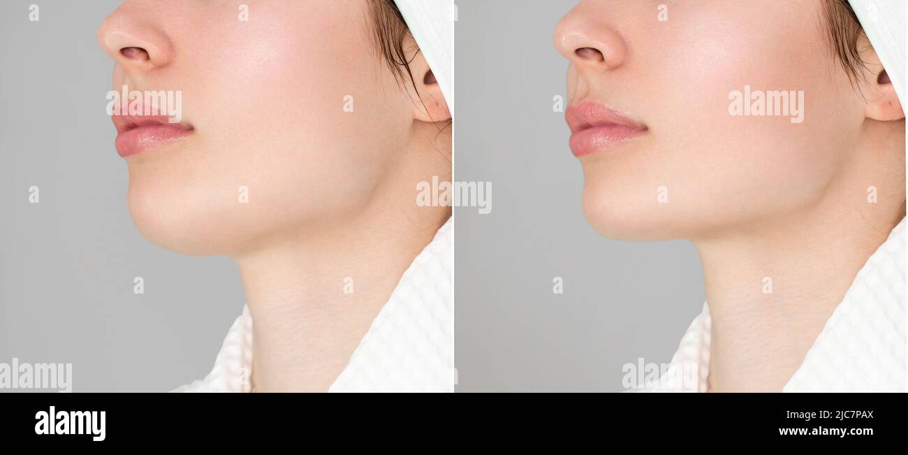 Correction of the chin shape liposuction of the neck. The result of the procedure in the clinic of aesthetic medicine. Stock Photo