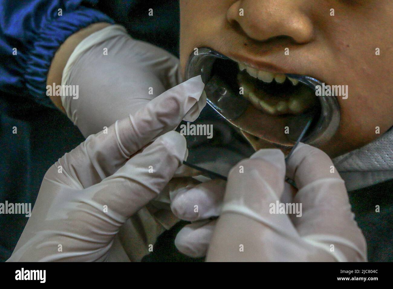 Dental and oral health checks for Cerebral Palsy children in Bogor City, West Java, Indonesia, on June 5, 2022. Stock Photo