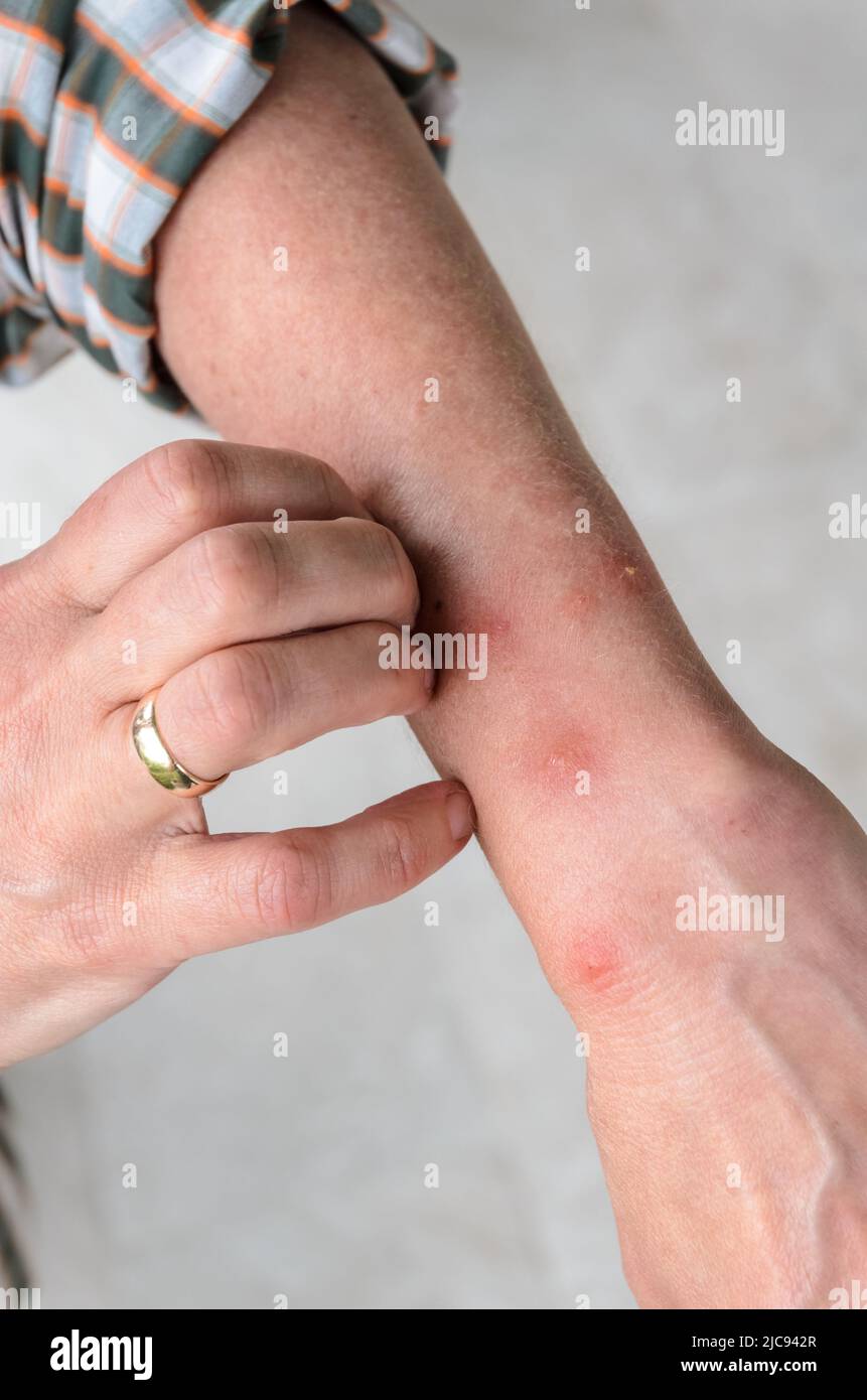 Allergic reaction to insect bites with round swelling spots on arm of a