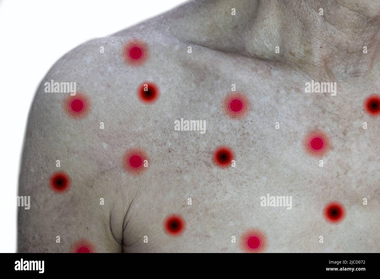 Monkeypox skin rashes over the trunk of Asian old man. Isolated on white. Stock Photo