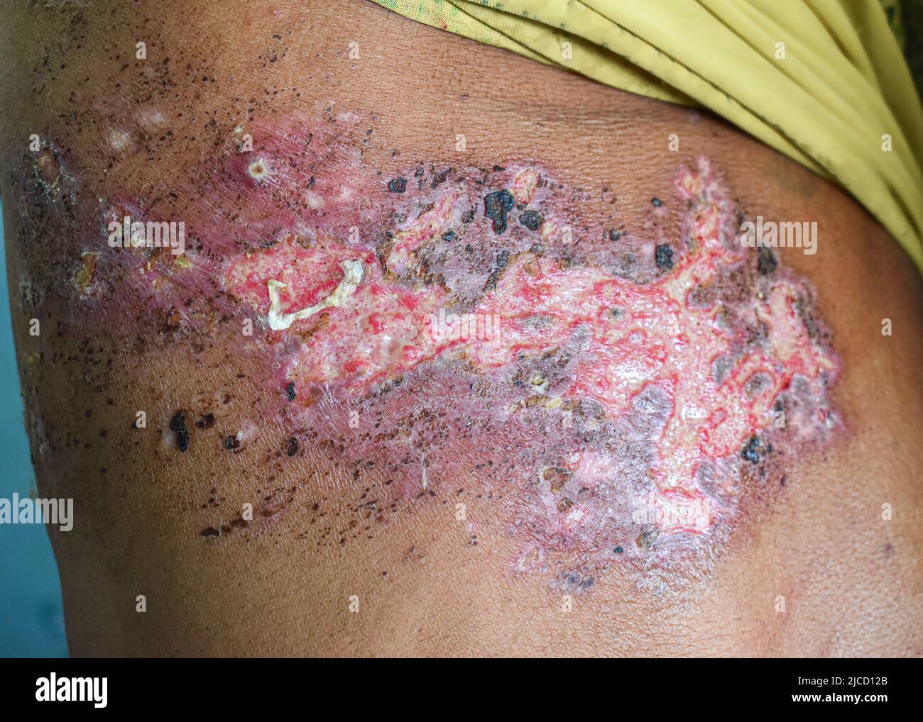 Herpes simplex infection at chest and abdomen of Asian man. Stock Photo
