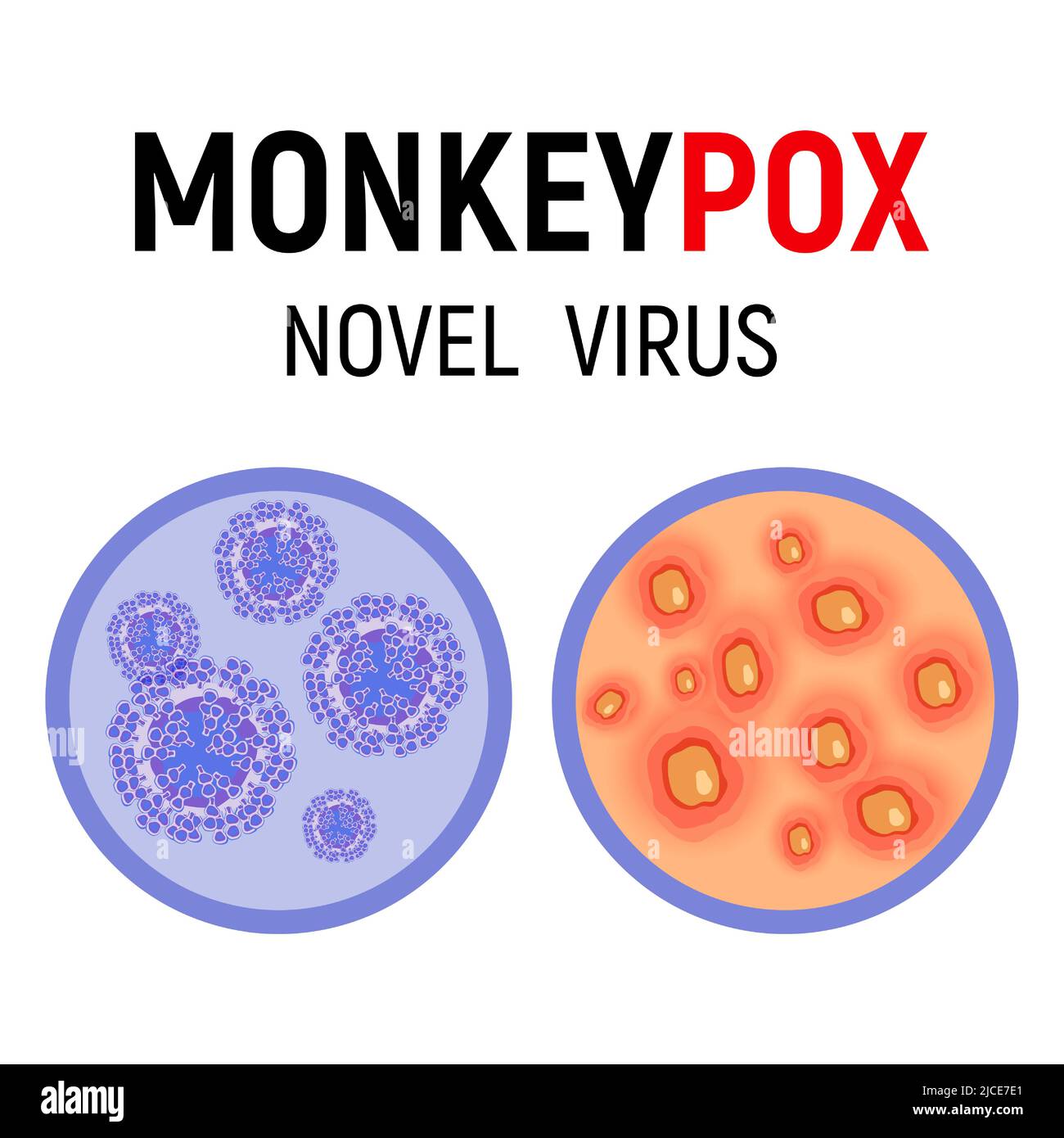 Monkeypox virus cells and human skin with rash, wounds and ulcers on a white background close-up. Monkeypox virus symptom. Vector illustration. Stock Vector