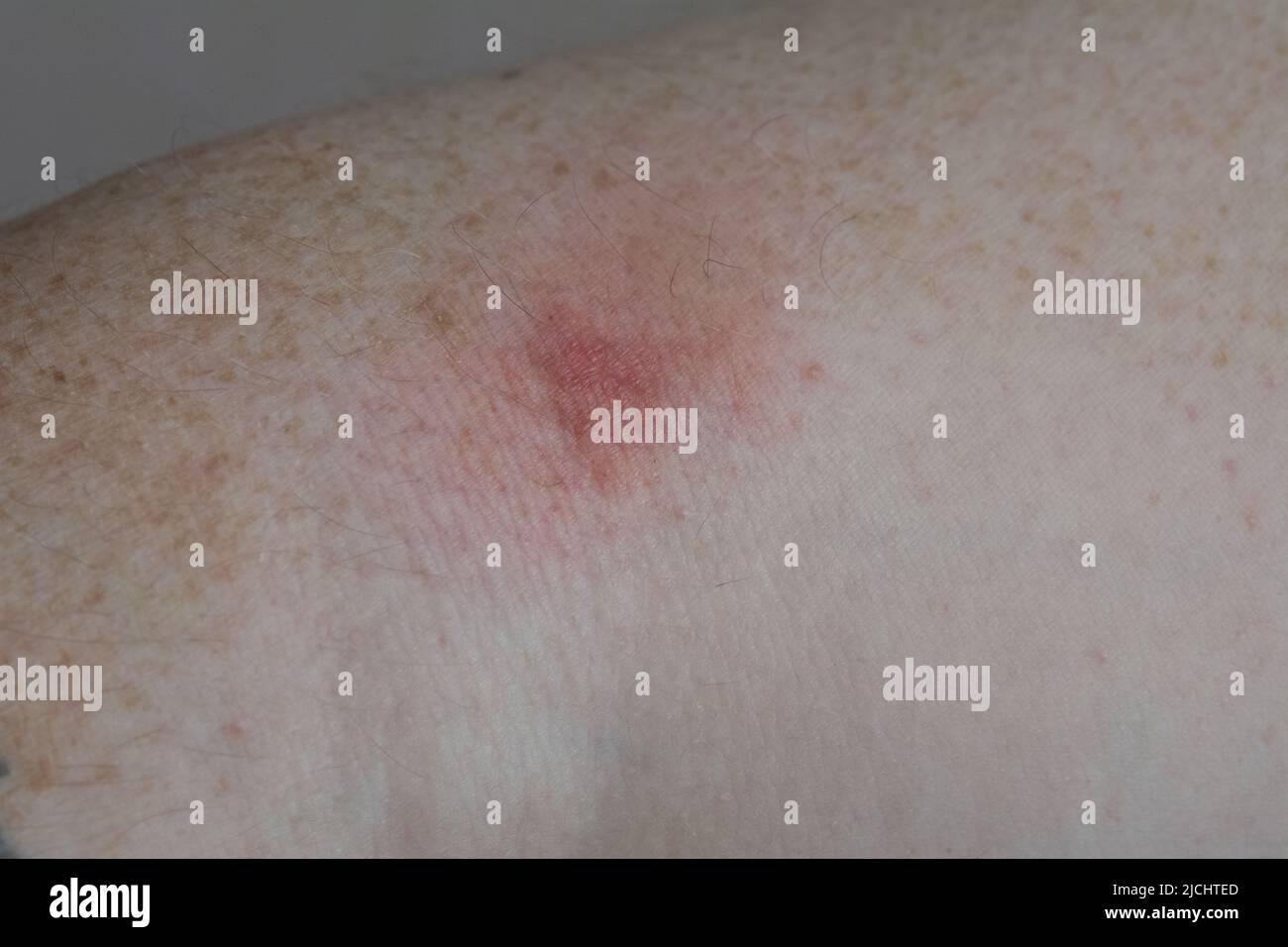 Irritation from an insect bite. Trace irritation from a bite by an unknown insect on the arm of a white European man Stock Photo