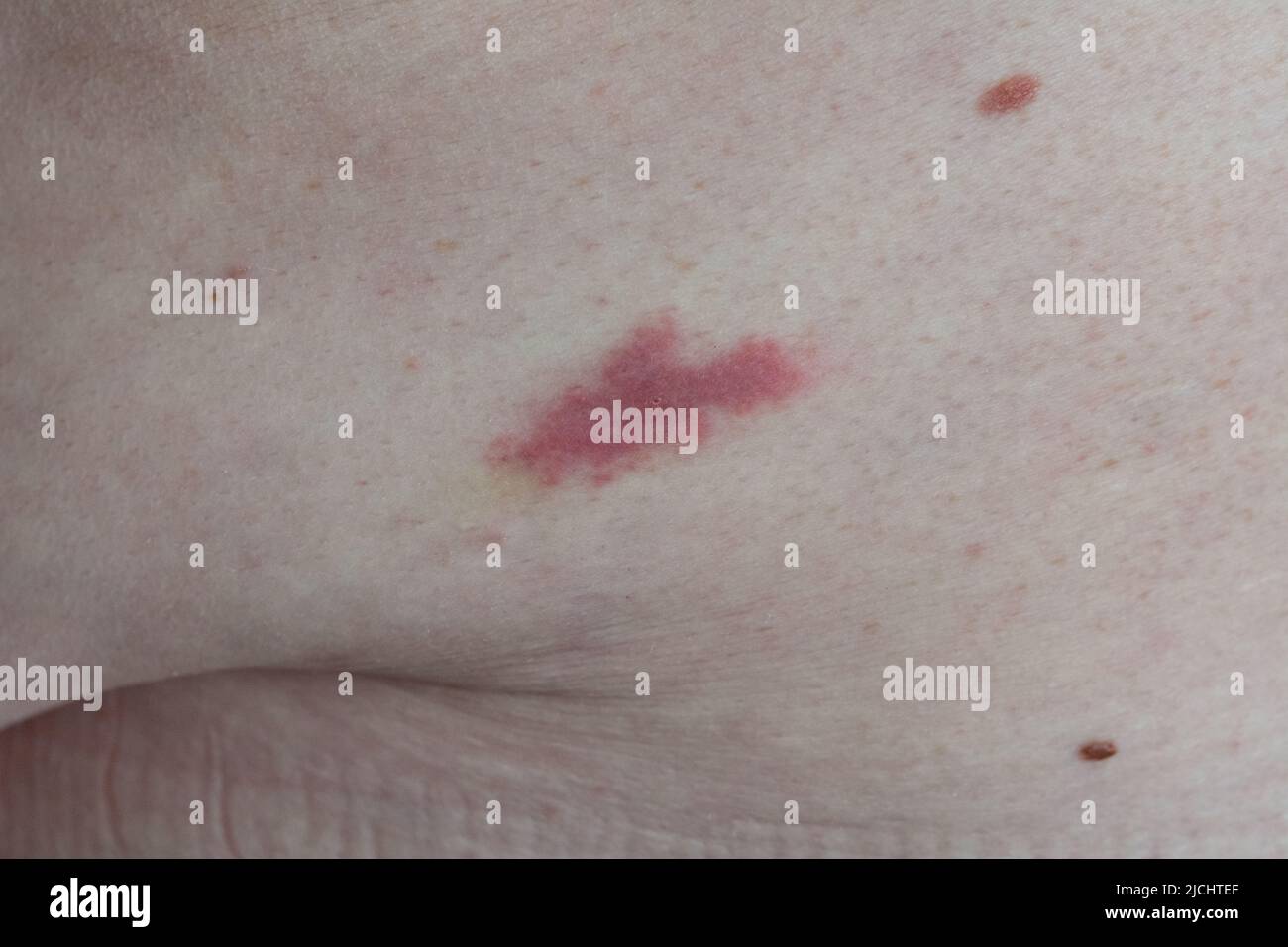 Irritation from an insect bite. Trace irritation from a bite by an unknown insect on the waist of an overweight white European man Stock Photo