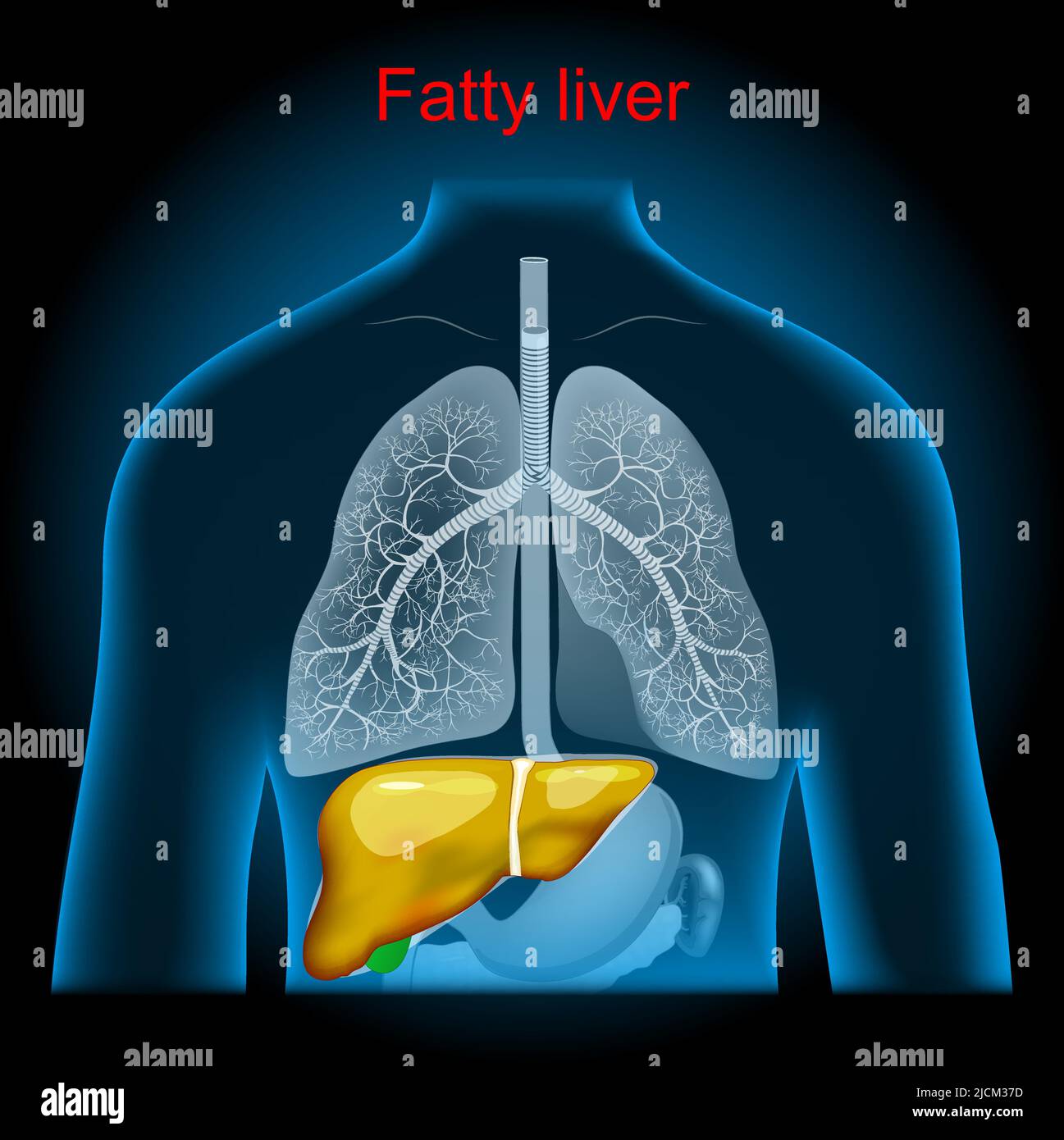 Fatty liver disease. Hepatic steatosis. excess fat builds up in the liver, stomach and lungs into x-ray blue realistic torso. Human silhouette on dark Stock Vector
