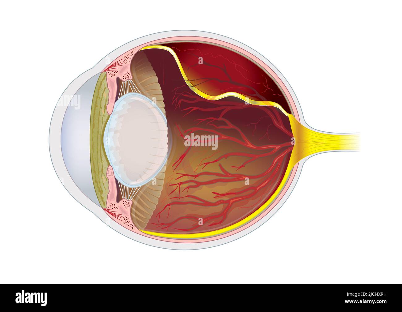 Cat eye with hypertension (high blood pressure), illustration