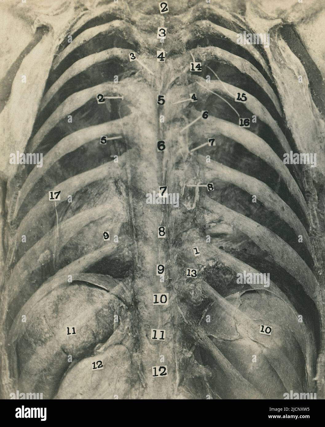 Dissection of a human cadaver showing the ribs, heart, liver and spine