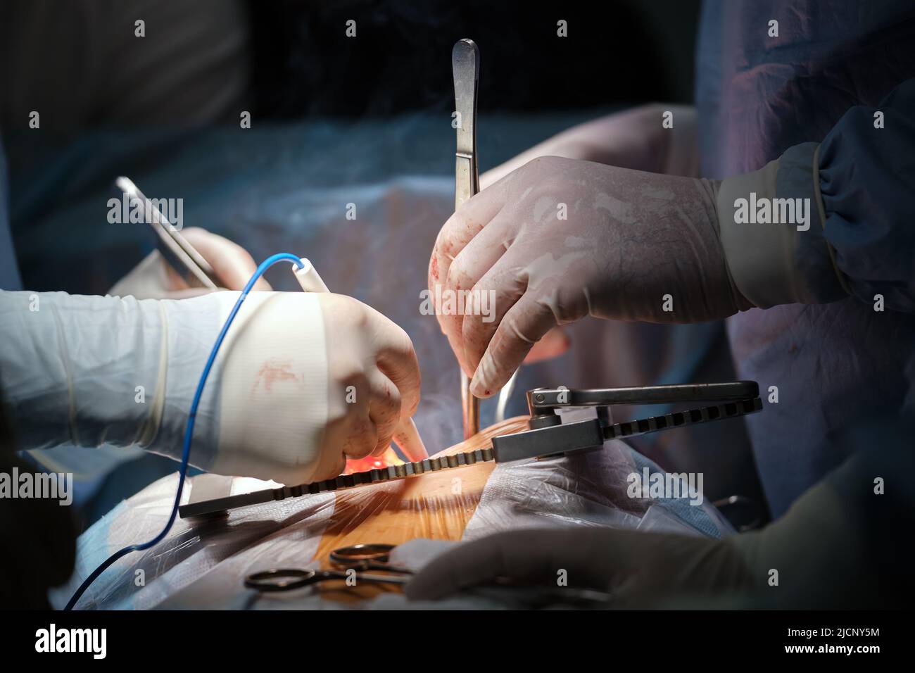 Heart transplant surgery hi-res stock photography and images - Alamy