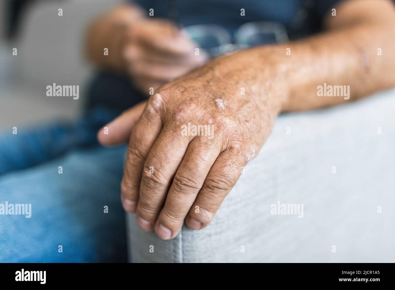 Elderly man suffering from psoriasis, closeup on hands Stock Photo