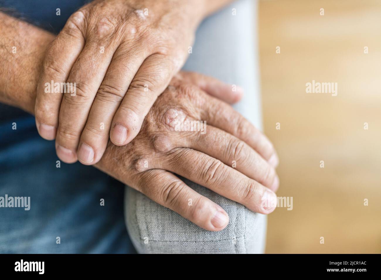 Elderly man suffering from psoriasis, closeup on hands Stock Photo