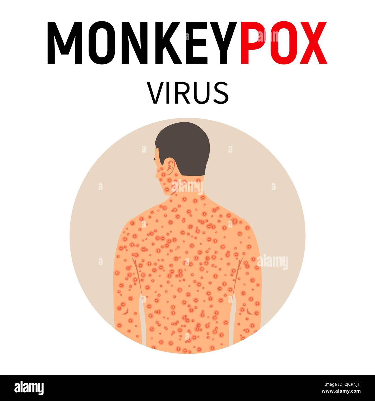 Monkeypox virus. A man with monkeypox with a rash all over his body. Disease symptoms. Viral infection. Vector illustration. Stock Vector