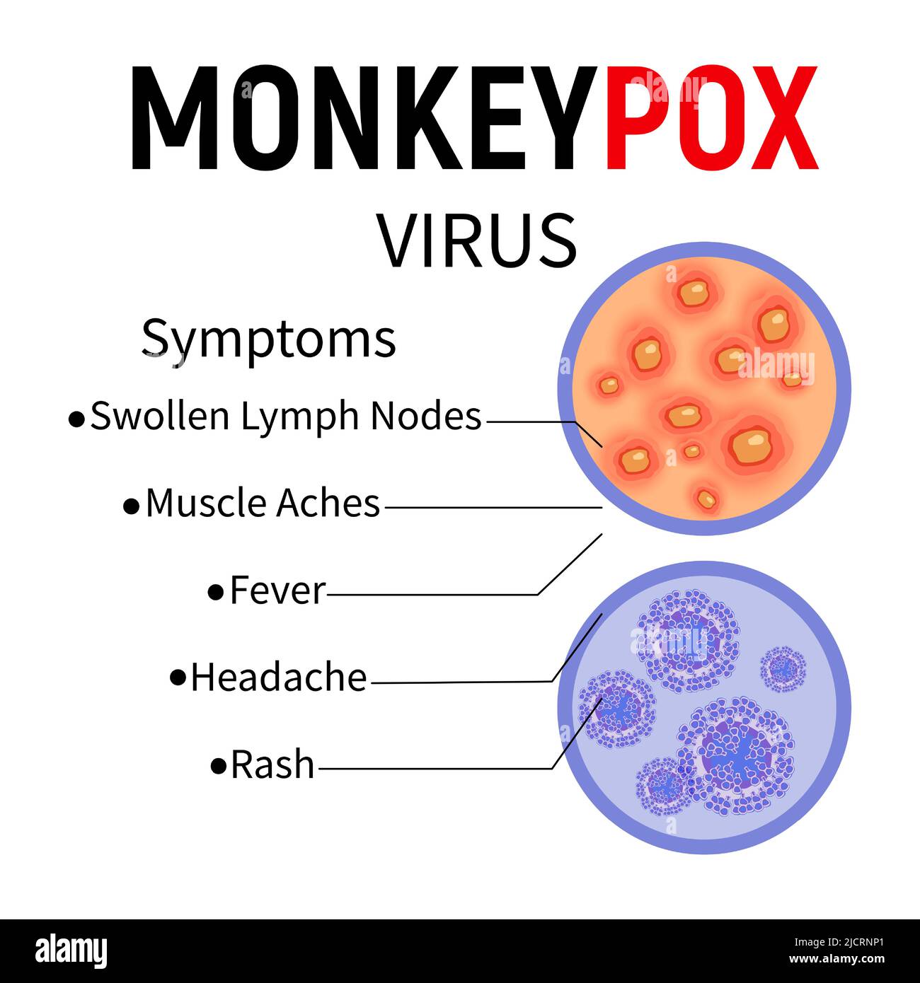 Monkeypox virus. Enlarged samples of human skin with ulcers and virus cells. Monkeypox disease symptoms infographic. Vector illustration. Stock Vector