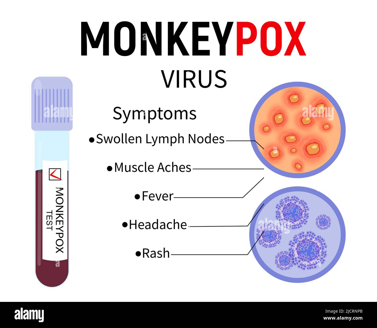 Test tube with blood for monkeypox virus test, human skin sample with rash and virus cells on white background. Symptoms of monkeypox. Vector Stock Vector