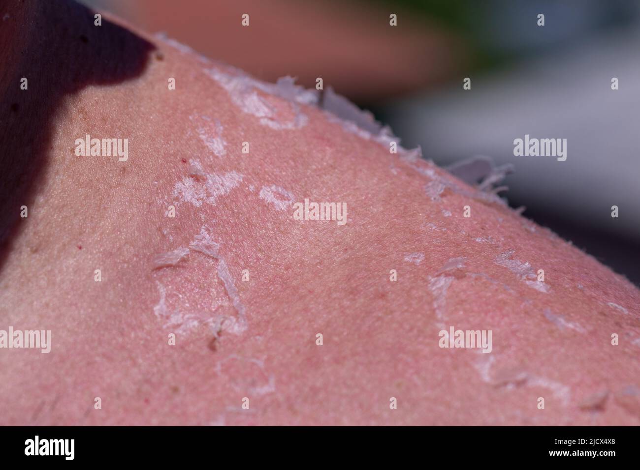 Sunburn. Closeup of Peeling sunburned skin on back and shoulder stock photo Stock Photo