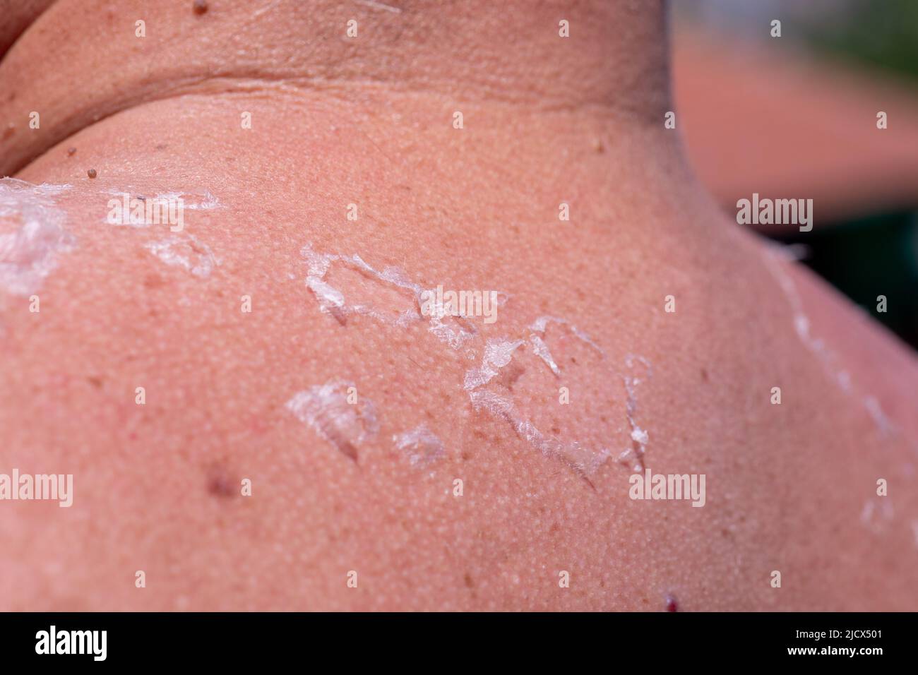 Sunburned Sunburn Peeling Skin Hi Res Stock Photography And Images Alamy