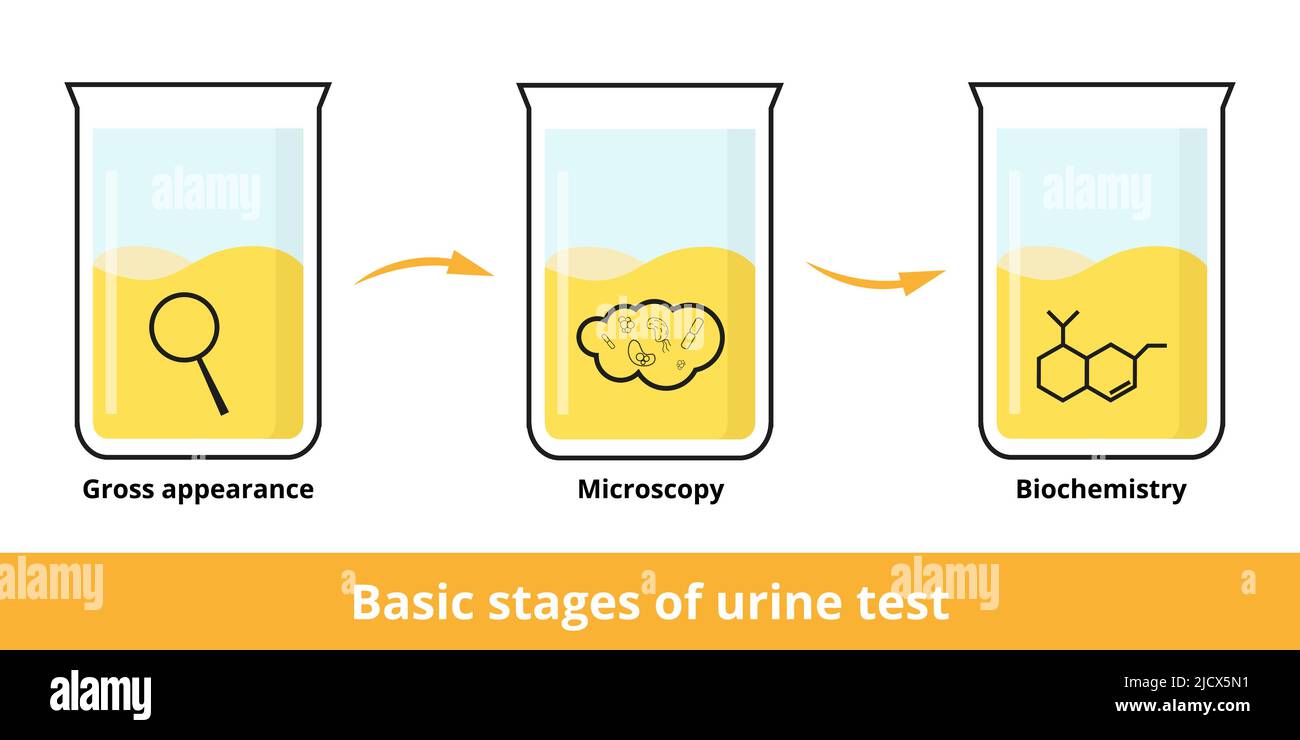 Basic stages of urine test. Urinalysis can include a visual exam (gross