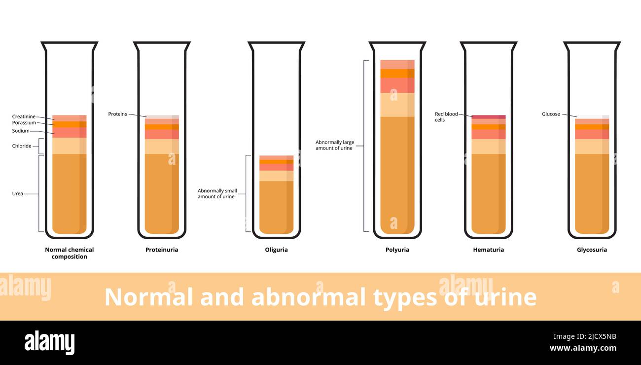 Normal сhemical сomposition of urine and its abnormal types.Common types of abnormal urine include proteinuria, oliguria, hematuria and glycosuria Stock Vector