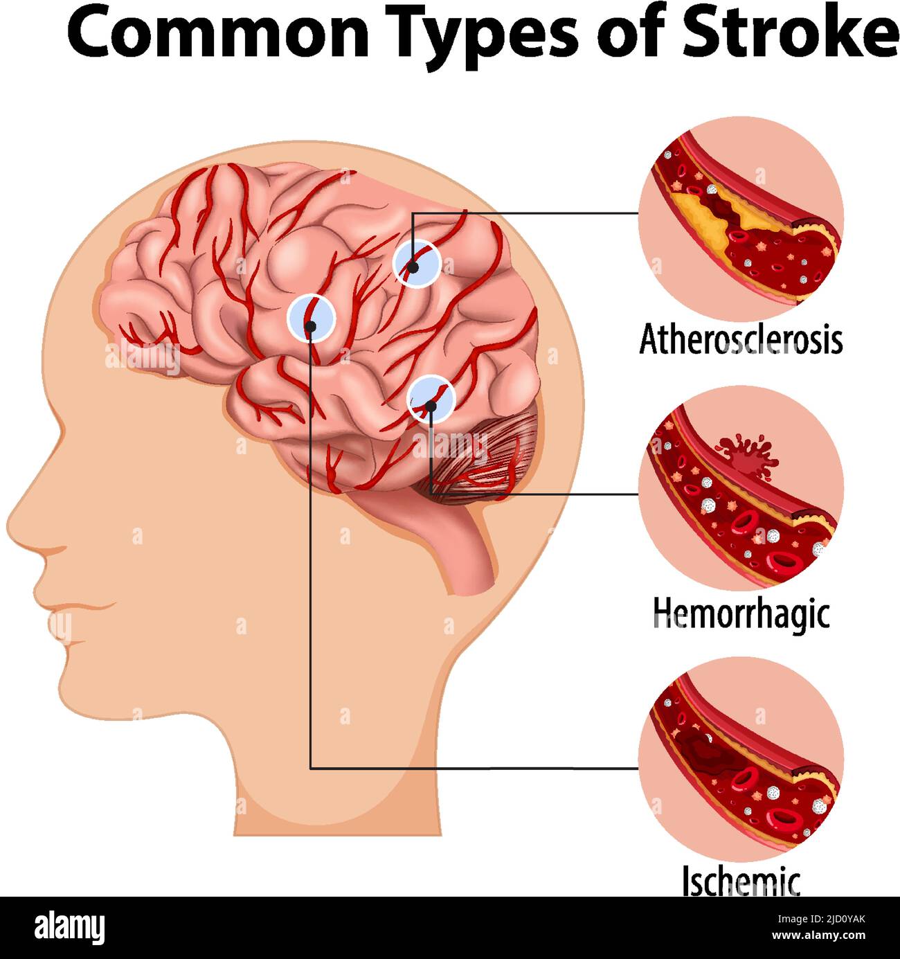 Different Types Of Strokes