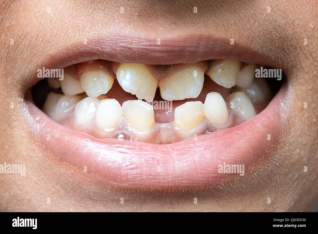 beautiful smile by press ceramic crown and venners Stock Photo